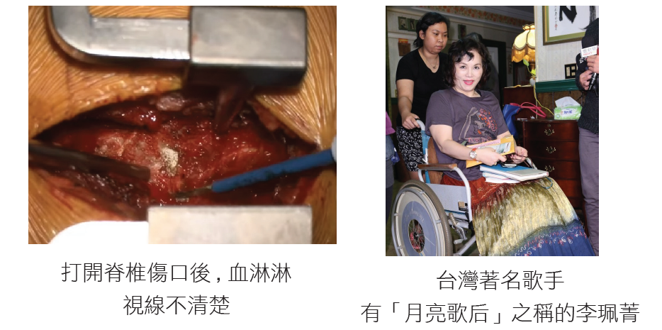 微創椎間盤切除手術